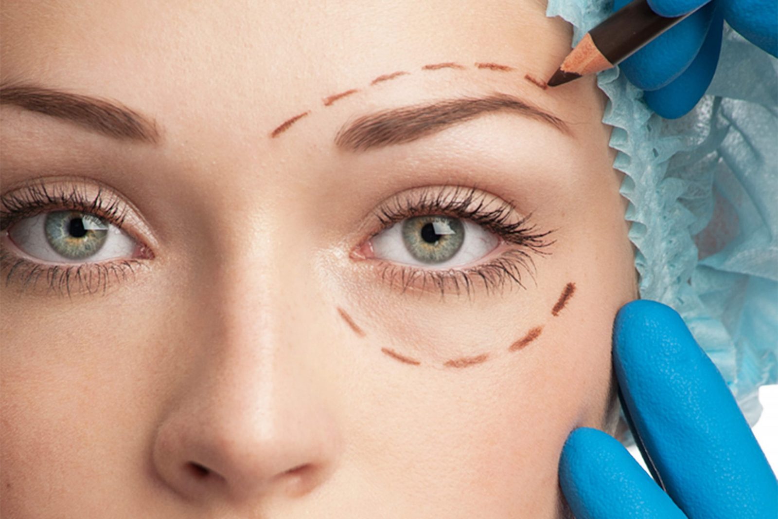 Блефаропластика (фото до и после) Самарцев Виктор Иванович